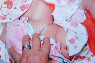 Gêmeas, nascidas há 10 dias, são ligadas pelo cóccix. Foto: Fábio Cortez/DN/D.A Press (Fábio Cortez/DN/D.A Press)