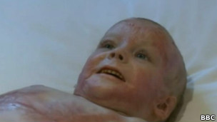 Pippie Kruger sobreviveu a queimaduras após cirurgia inédita de reconstrução de pele.Foto: BBC