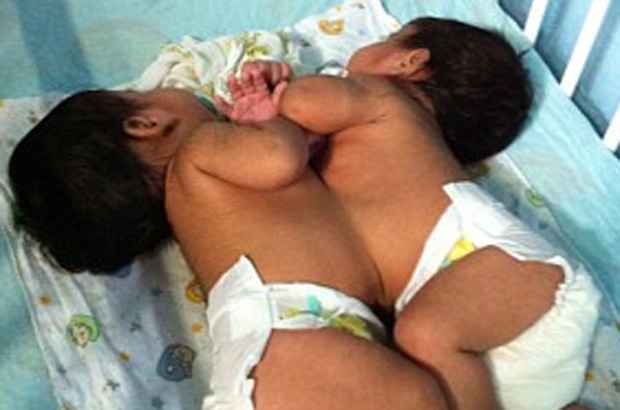 Bebês serão submetidos à cirurgia de separação.Foto: Reprodução/ TV Clube