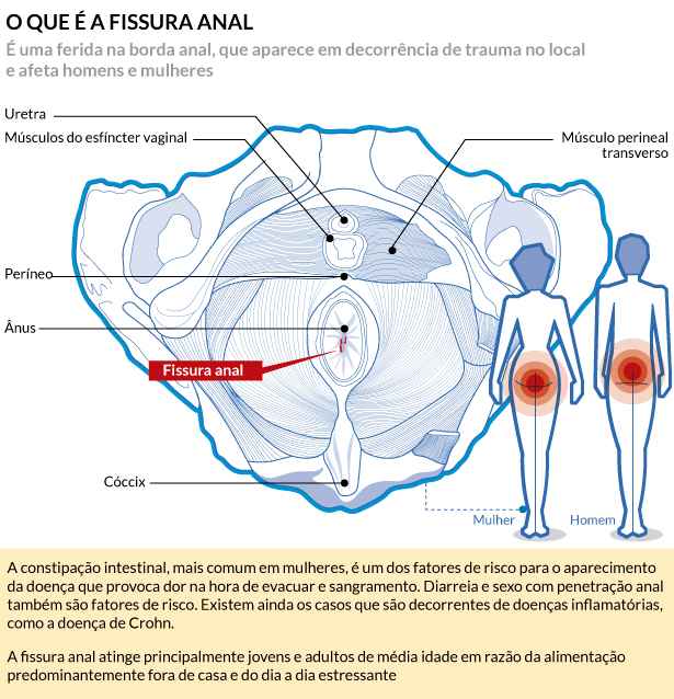 Fissura Anal O Que Você Precisa Saber Mas Sente Constrangimento Em